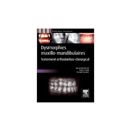 Dysmorphies maxillo-mandibulaires